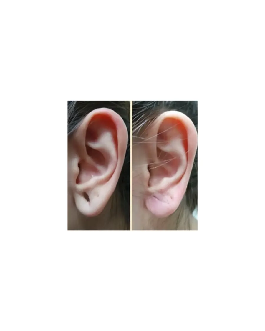 Advanced Earlobe Restoration with Ear Lobe Repair at Cinch Clinics